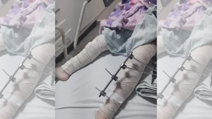 MaisPB • Trauma afasta médicos que realizaram cirurgia na perna errada de uma criança