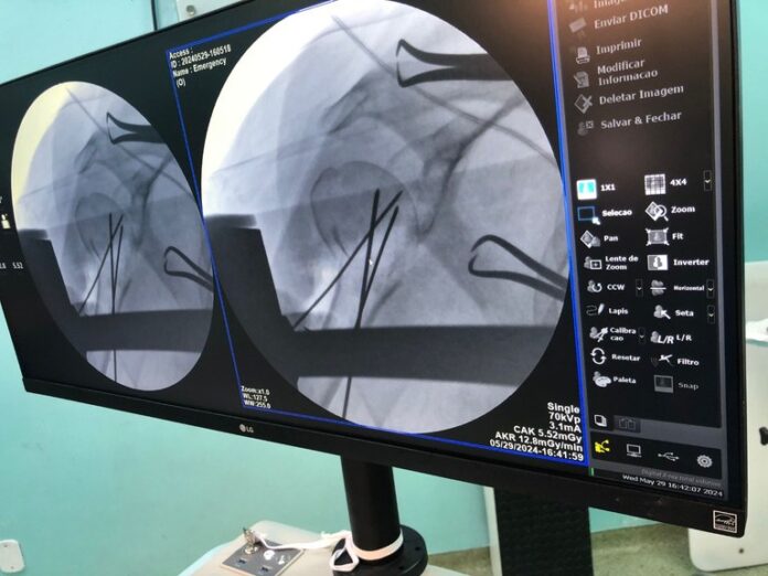 MaisPB • Trauma utiliza tecnologia pioneira em cirurgias de ombro