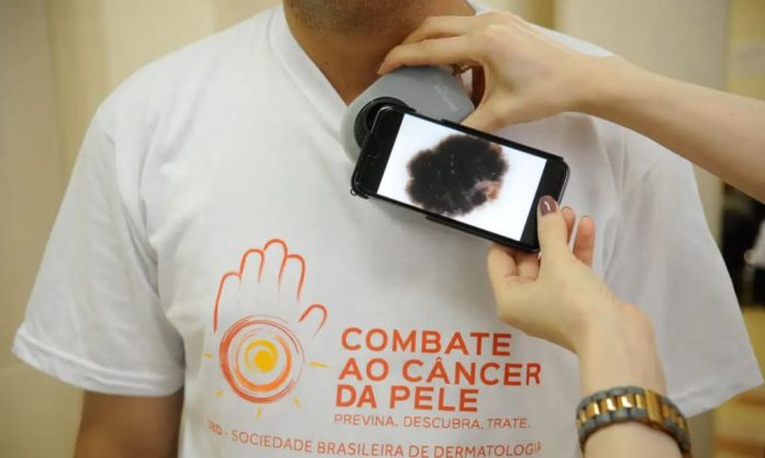 câncer de pele